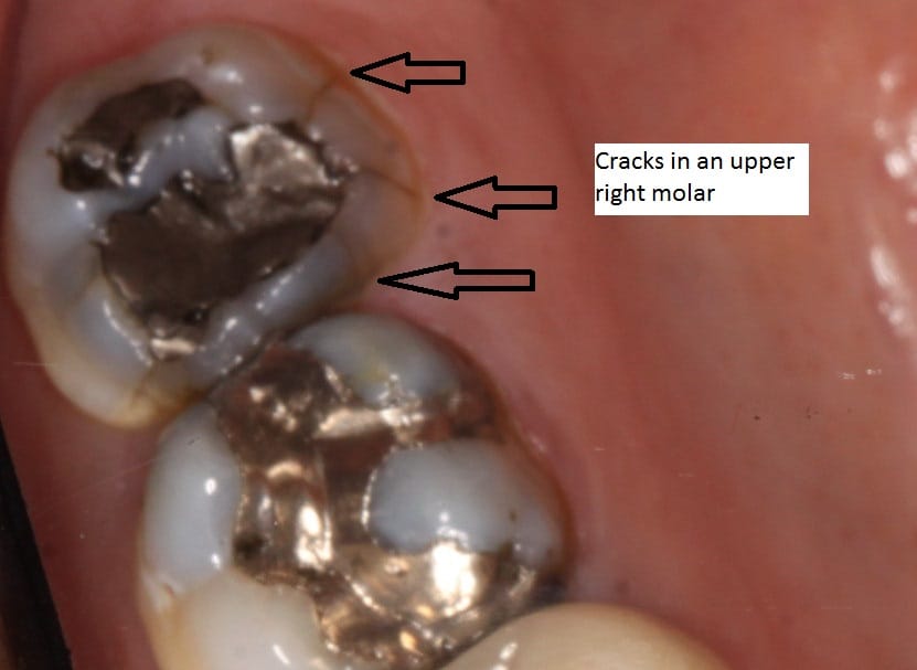 Cary Family Dental Cracked Molar Needs Crown