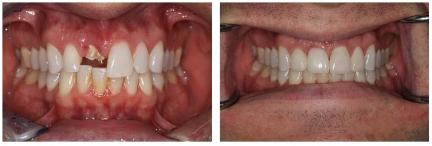 Cary Family Dental Smile Makeover Before and after Implants retracted