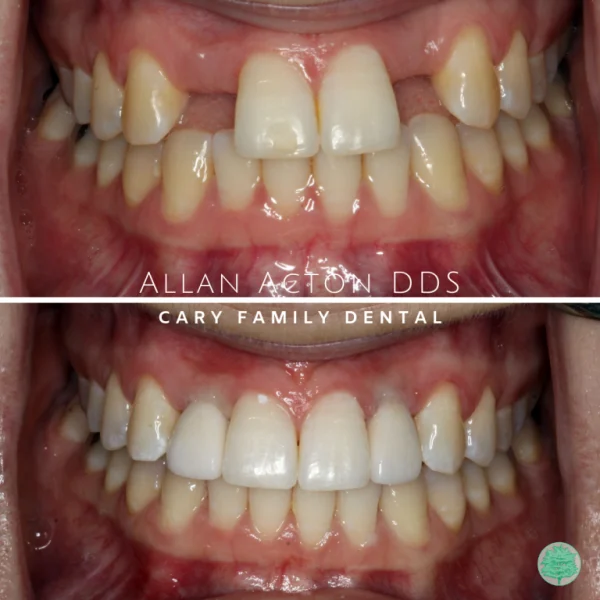 dental_implants-768x768