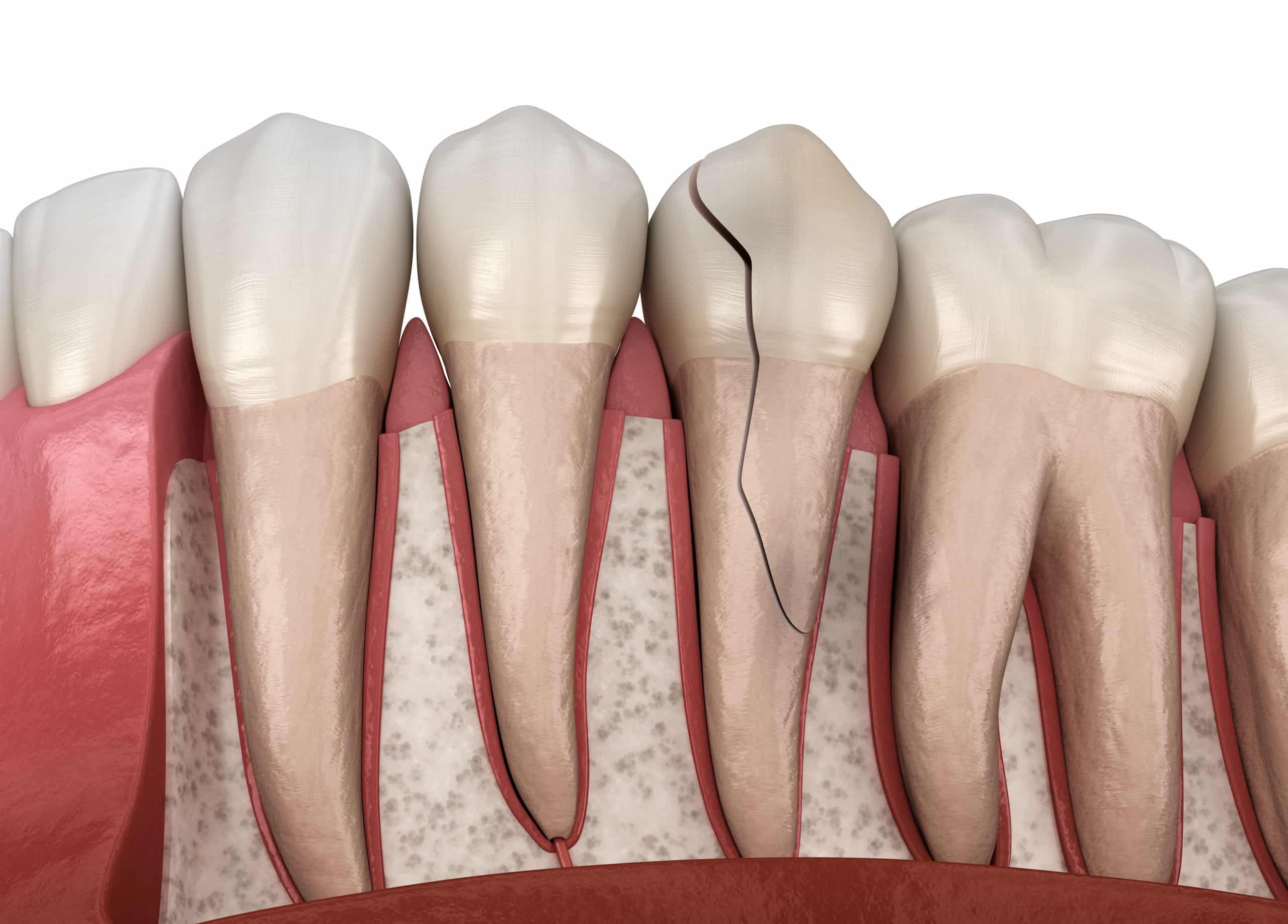 Broken Cracked Tooth Repair - Cary Dental NC