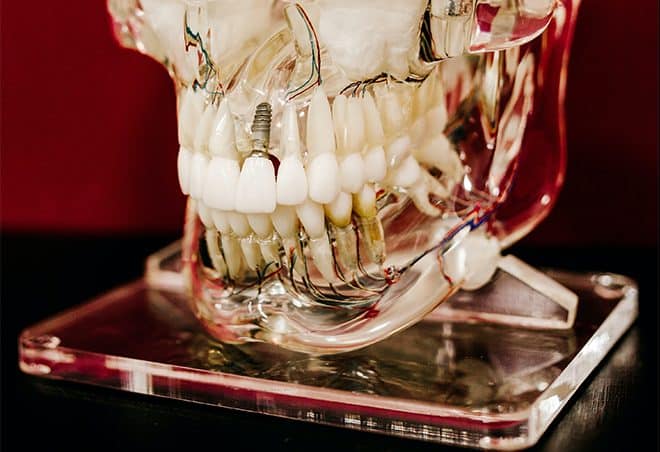 Dental implants demonstration of implants in a clear jaw