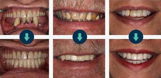 Dental implant before and after photos