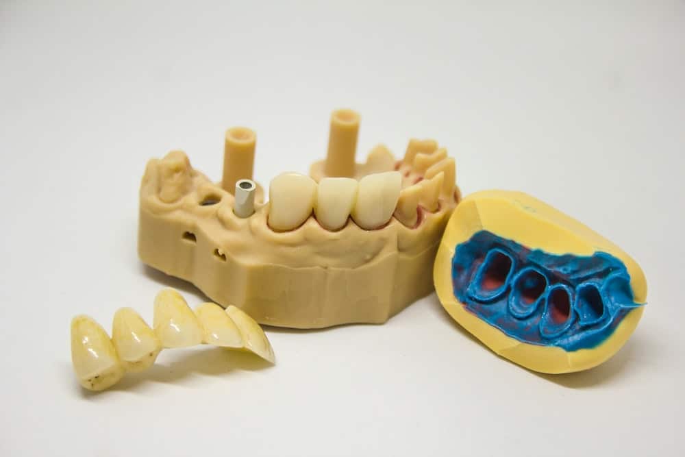 A mold for creating replacement teeth to be used in an implant supported bridge
