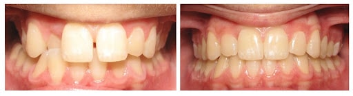 Before and after photos of patient teeth who received Invisalign clear braces at Cary Family Dental