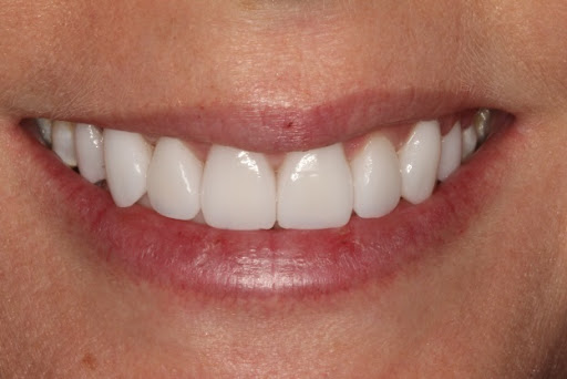 After photo of smile makeover dental bonding patient teeth